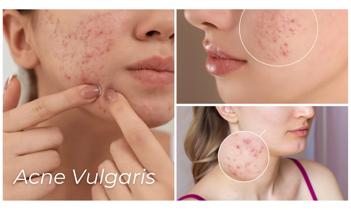 An In-depth Understanding of Acne Vulgaris: Essential Practices, Presentations, Treatments and Prevention