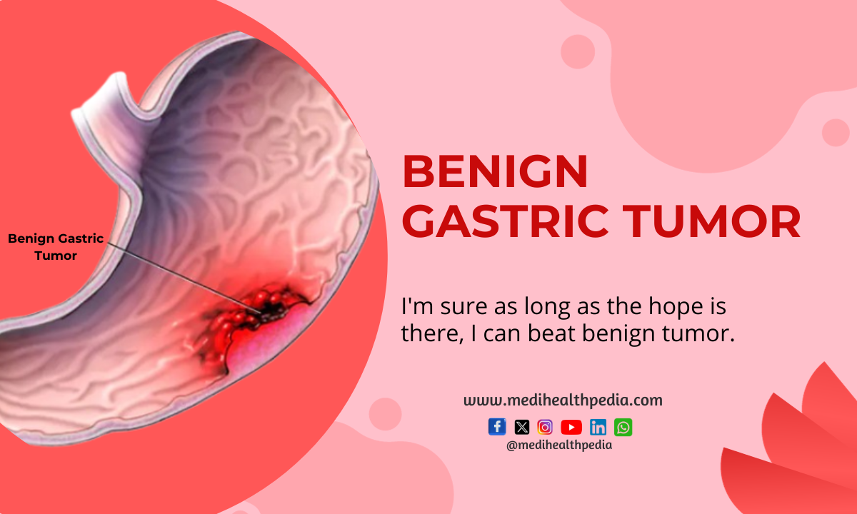 Benign Gastric Tumor